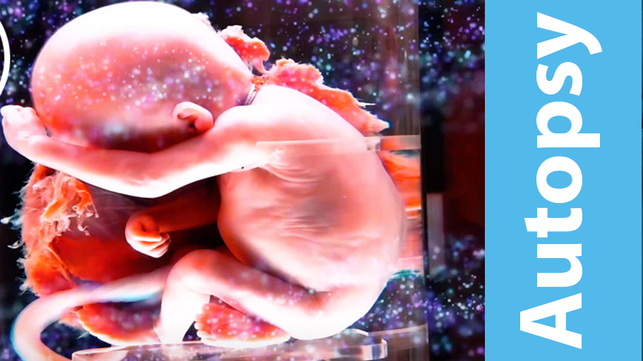 placenta and fetal autopsy; Review of pregnancy products